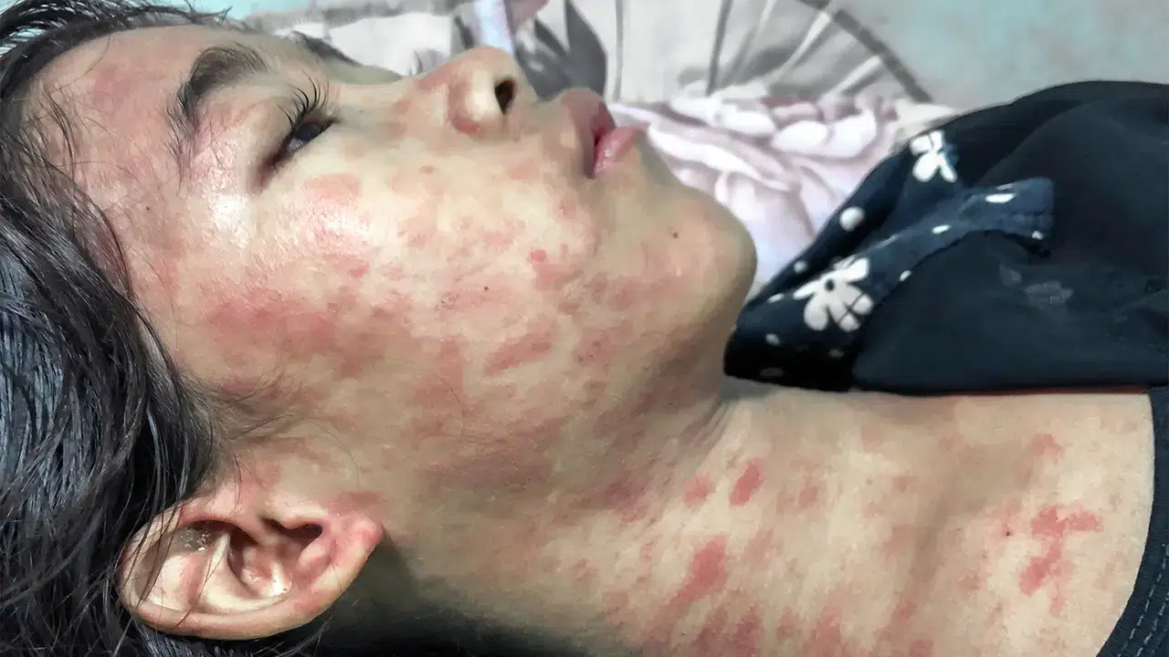 Çin’de Yeni Virüs Alarmı: Chikungunya Vakaları 1700’ü Aştı, Acil Durum İlan Edildi