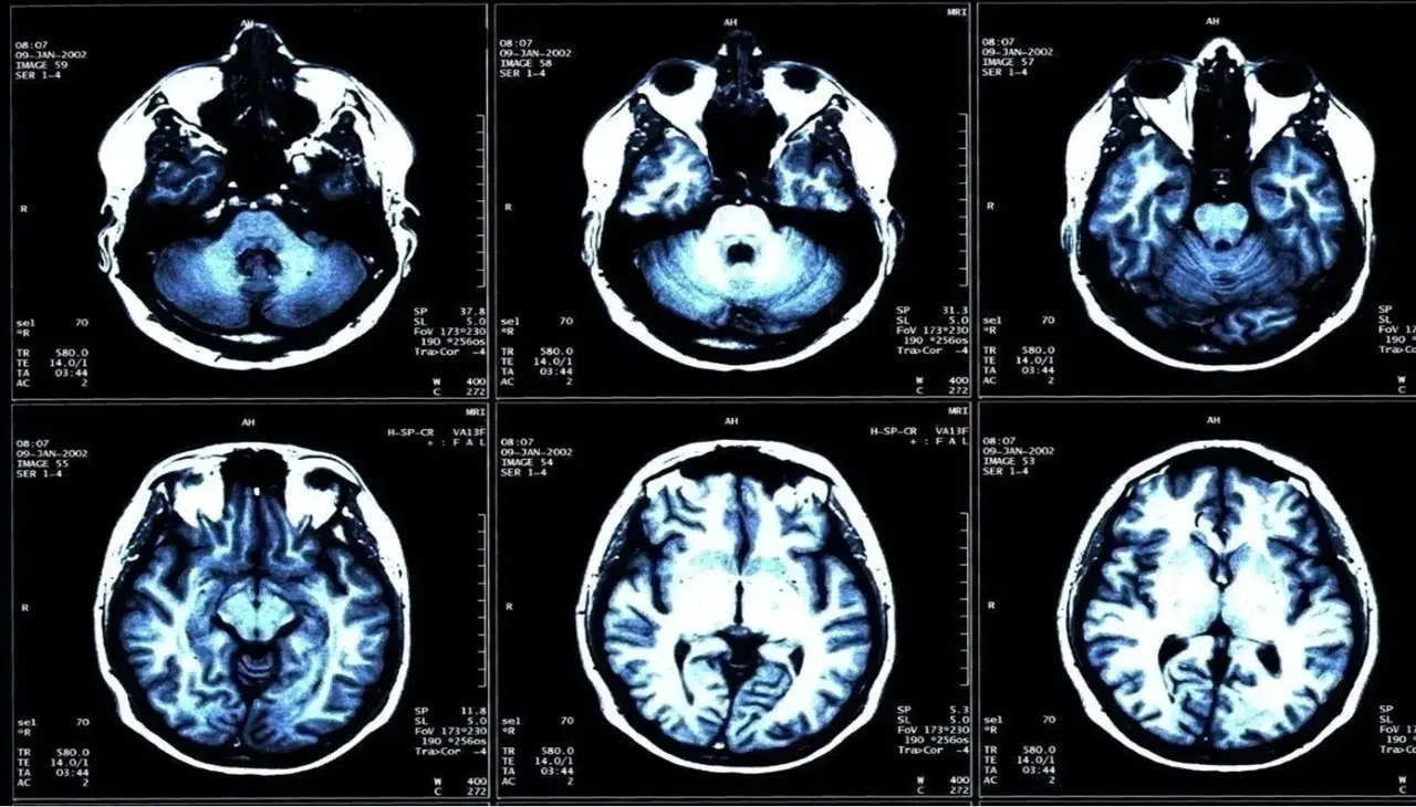 İyot Eksikliği Beyni ve Vücudu Sessizce Etkiliyor: Uzmanlardan Kritik Uyarı!