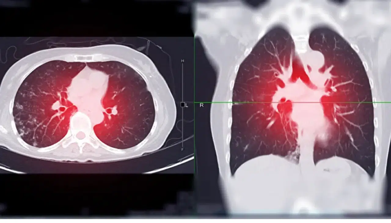 Akciğer Kanseri Alarm Veriyor: Son 5 Yılda Vakalar Yüzde 15 Arttı, Basit Öksürükle Başlayıp Ölümle Sonuçlanabiliyor