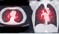 Akciğer Kanseri Alarm Veriyor: Son 5 Yılda Vakalar Yüzde 15 Arttı, Basit Öksürükle Başlayıp Ölümle Sonuçlanabiliyor