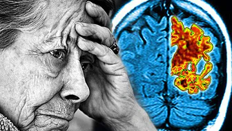 Günlük Yaşamda Görülen Küçük Değişiklikler Alzheimer’ın Erken Habercisi Olabilir