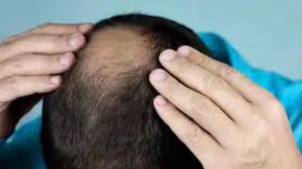 Yeni Tedavi Saç Çıkışını Yüzde 539 Artırdı