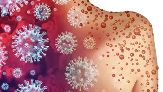 İspanya’da Alarm: Maymun Çiçeği Virüsünün En Tehlikeli Türü İlk Kez Tespit Edildi