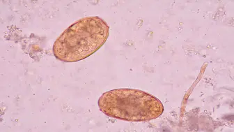 Vücuda sızıp yıllarca fark edilmiyor: 78 ülkede görülen sinsi parazit alarmı