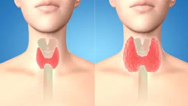 Tiroidi Sessizce Çökerten Üçlü Tehlike