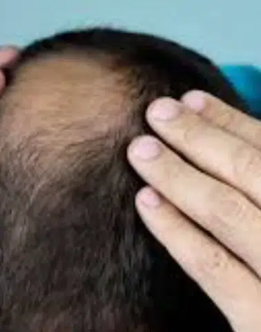 Yeni Tedavi Saç Çıkışını Yüzde 539 Artırdı