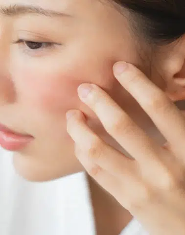 Soğuk Hava Cildi Zorluyor: Uzmanlardan Kuruluk ve Tahrişe Karşı Kış Uyarıları