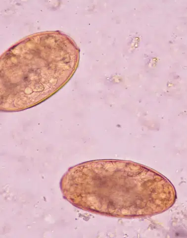 Vücuda sızıp yıllarca fark edilmiyor: 78 ülkede görülen sinsi parazit alarmı