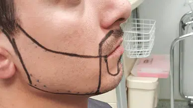 Köselik Nedir, Erkekler Neden Köse Olur?