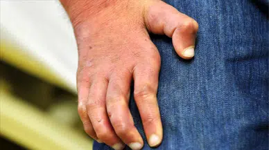 Skrotal Angiokeratoma Belirtileri ve Tedavisi