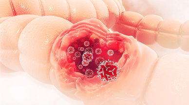 Bağırsak Kanseri Tehlikesi Artıyor: Dikkat Edilmesi Gereken 3 Kritik İşaret