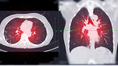 Akciğer Kanseri Alarm Veriyor: Son 5 Yılda Vakalar Yüzde 15 Arttı, Basit Öksürükle Başlayıp Ölümle Sonuçlanabiliyor