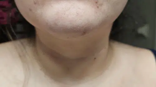 Ergenlik dönemi sağlığı etkiliyor