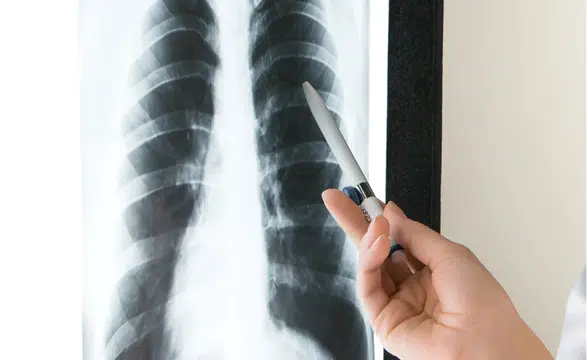 Yapay Zekâ ile Beyin Ameliyatı