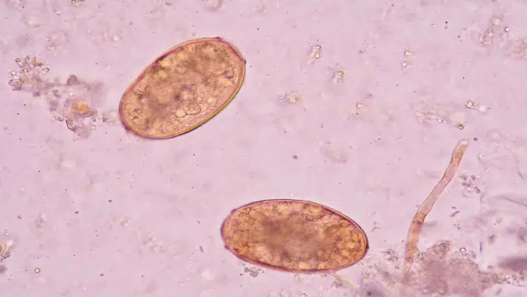 Vücuda sızıp yıllarca fark edilmiyor: 78 ülkede görülen sinsi parazit alarmı