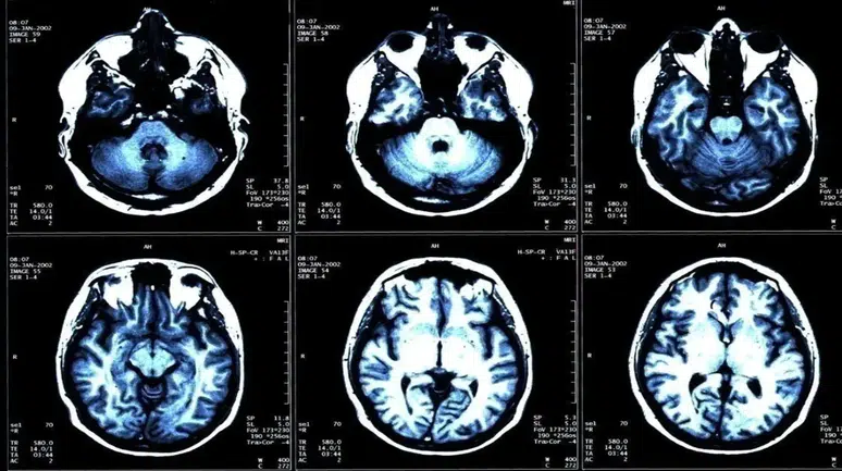 İyot Eksikliği Beyni ve Vücudu Sessizce Etkiliyor: Uzmanlardan Kritik Uyarı!