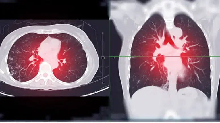 Akciğer Kanseri Alarm Veriyor: Son 5 Yılda Vakalar Yüzde 15 Arttı, Basit Öksürükle Başlayıp Ölümle Sonuçlanabiliyor