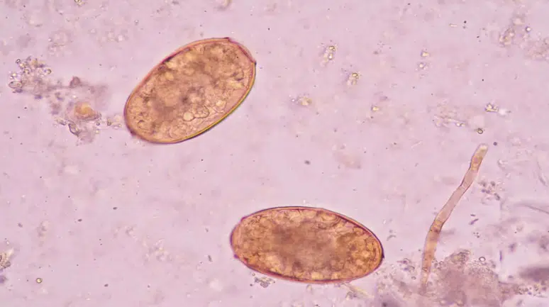 Vücuda sızıp yıllarca fark edilmiyor: 78 ülkede görülen sinsi parazit alarmı